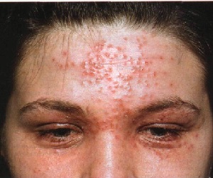 экзема на лице