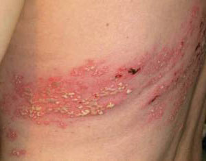 симптомы опоясывающего лишая фото