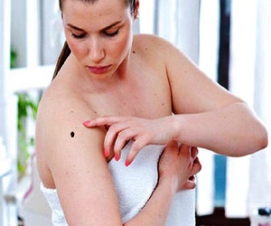 расположение родинок и их значение