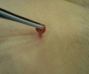 вирус папилломы человека у мужчин