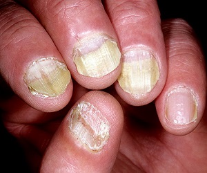 псориаз ногтей фото на ногах