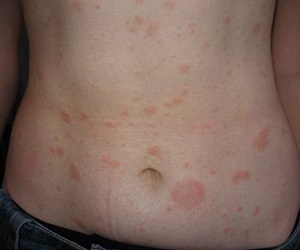 розовый лишай жибера фото