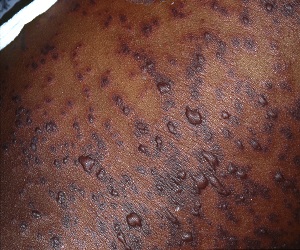 синдром лайелла