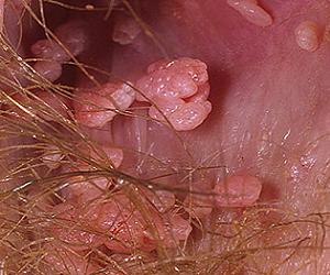 остроконечные кондиломы у женщин фото