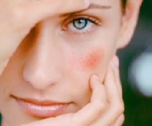 сосудистые звездочки на лице