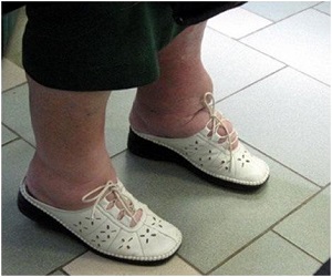 отек левой ноги у женщин