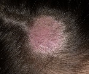 микоз у детей фото