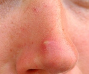 прыщи на носу причины у женщин