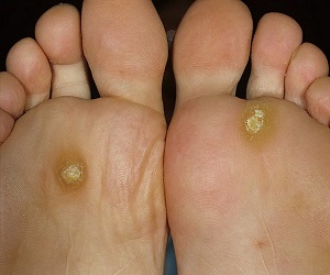 как избавиться от шипицы на ступне