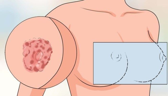 Экзема на сосках