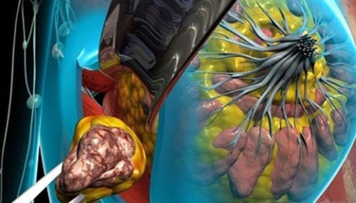 Лампэктомия