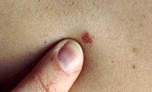 родинки на лице фото