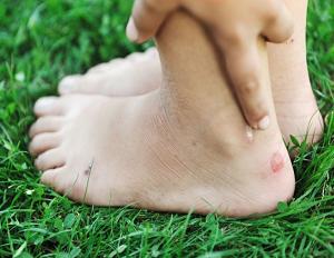 мозоли на пятках фото