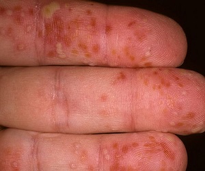 как вылечить мокнущую экзему