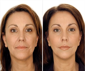 мезотерапия фото до и после