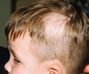 стригущий лишай у ребенка фото