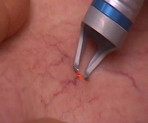 варикоз что делать