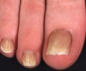 псориаз ногтей лечение в домашних условиях