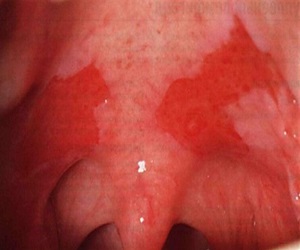 красный плоский лишай лечение мазь