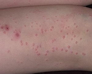 контагиозный моллюск