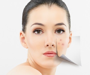 маски от следов от прыщей