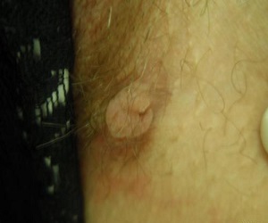 лечение фибромы