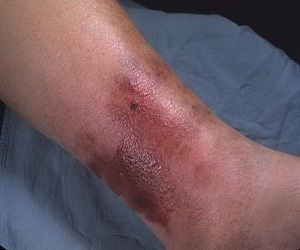 рожа на ноге лечение народными средствами