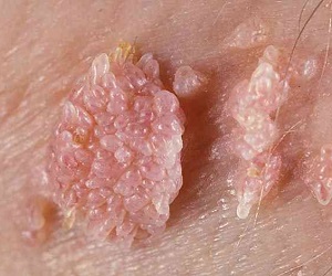 вирус папилломы человека