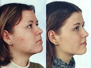 демодекоз лечение на лице фото