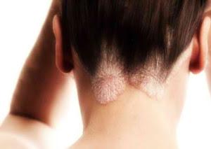 псориаз волосистой части головы фото