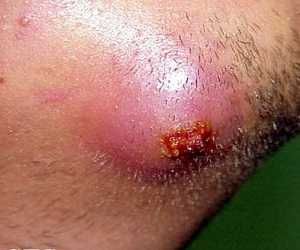 карбункул профилактика