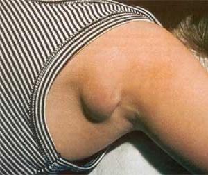 гидраденит под мышкой фото