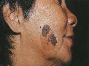 себорейная кератома лечение фото