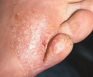 эпидермофития стоп лечение фото