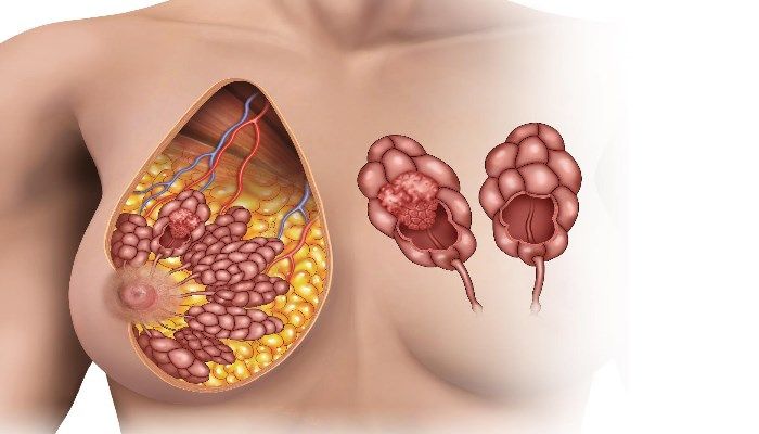 Рак молочных желез