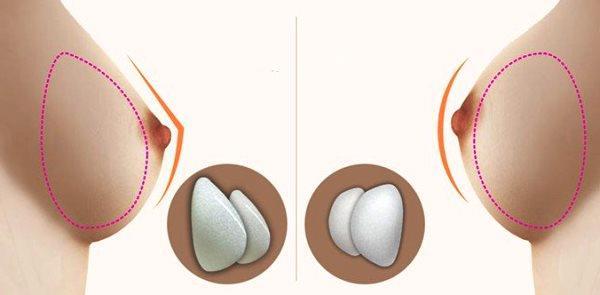Аугментационная маммопластика Аугментационная маммопластика