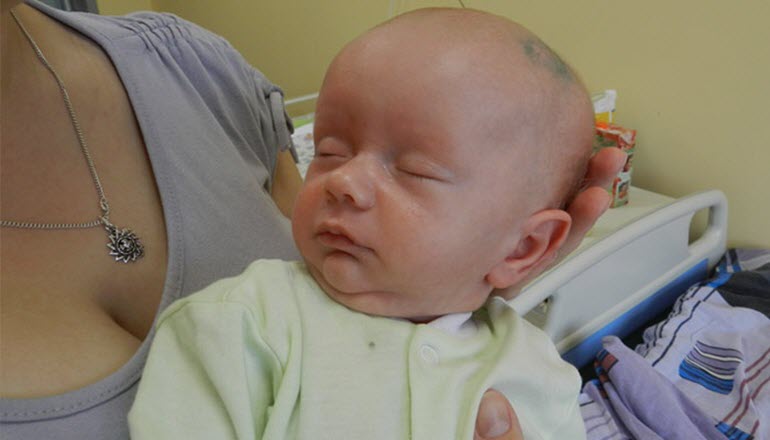 Гидроцефальный синдром