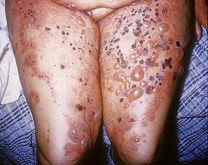 вульгарная пузырчатка фото