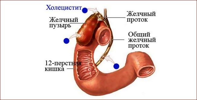 Холецистит