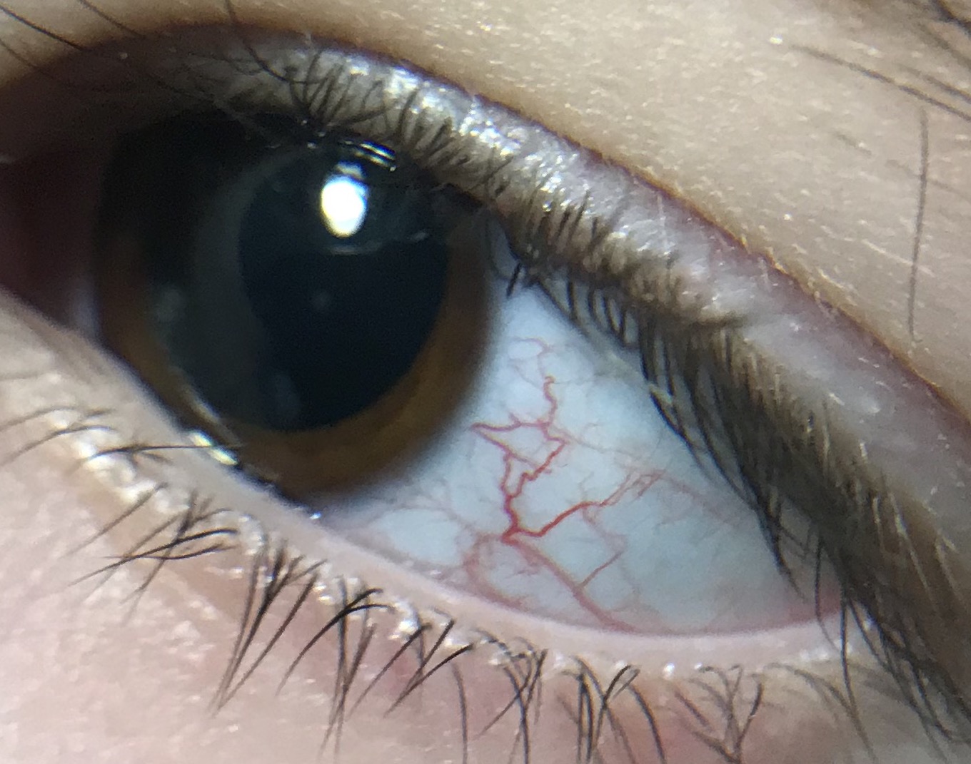 Глазные проявления синдрома Луи -Бар