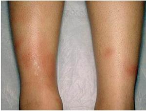 узловатая эритема на ногах фото