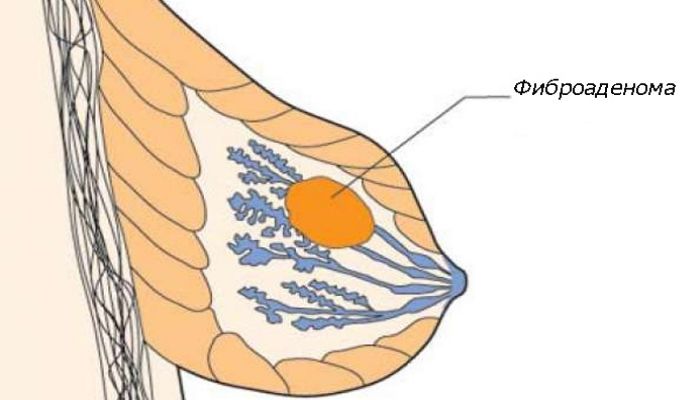 Фиброаденома