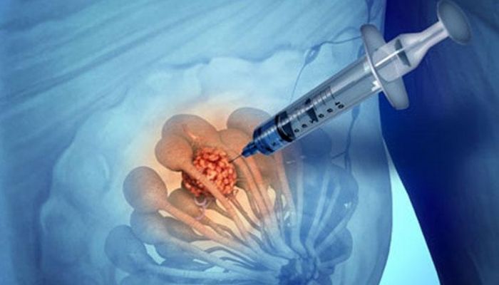 Биопсия молочной железы