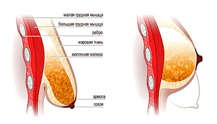 Мастопексия