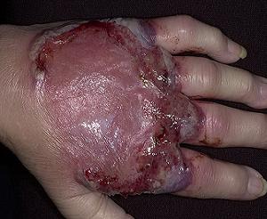 пиодермия фото лечение симптомы