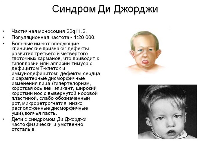 Синдром Ди Джорджи