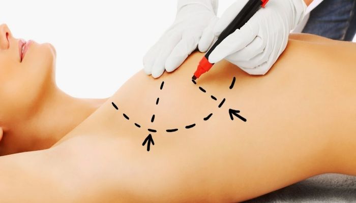 Операция по маммопластике