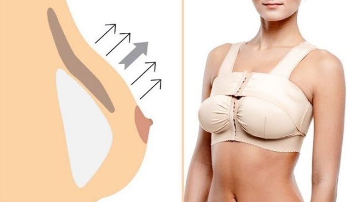 Компрессионный бюстгальтер