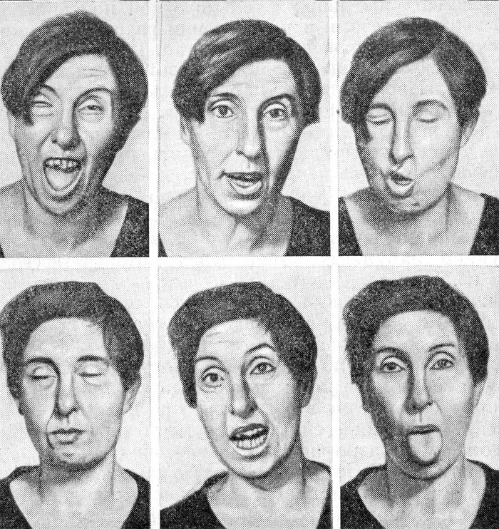 Симптомы хореи Гентингтона