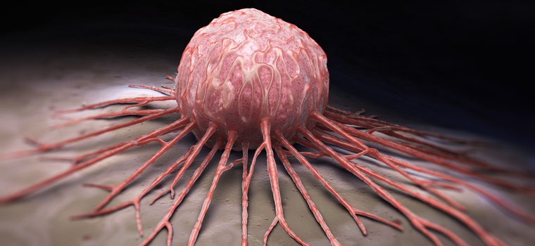 Атерома Атерома